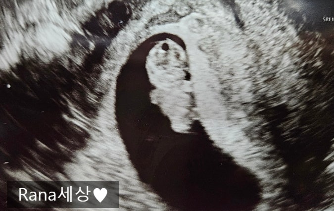  [임신일기] 마음의 안정을 찾은 임신 8주차 증상, 초음파, 식단