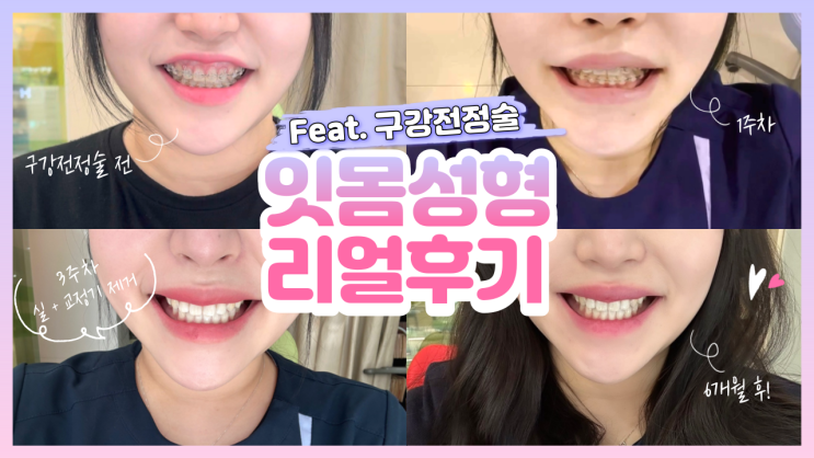  웃을 때 입술 말림, 구강전정술 입술재배치술로 해결