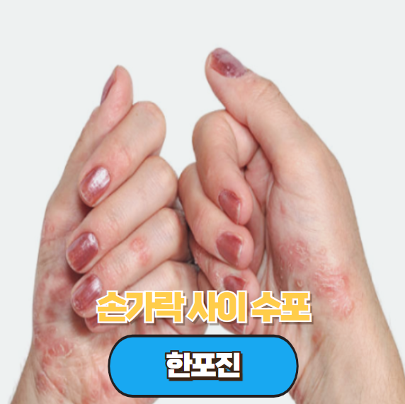손가락사이수포 손가락 수포 원인 가려움 손등 한포진 물집 해결방안