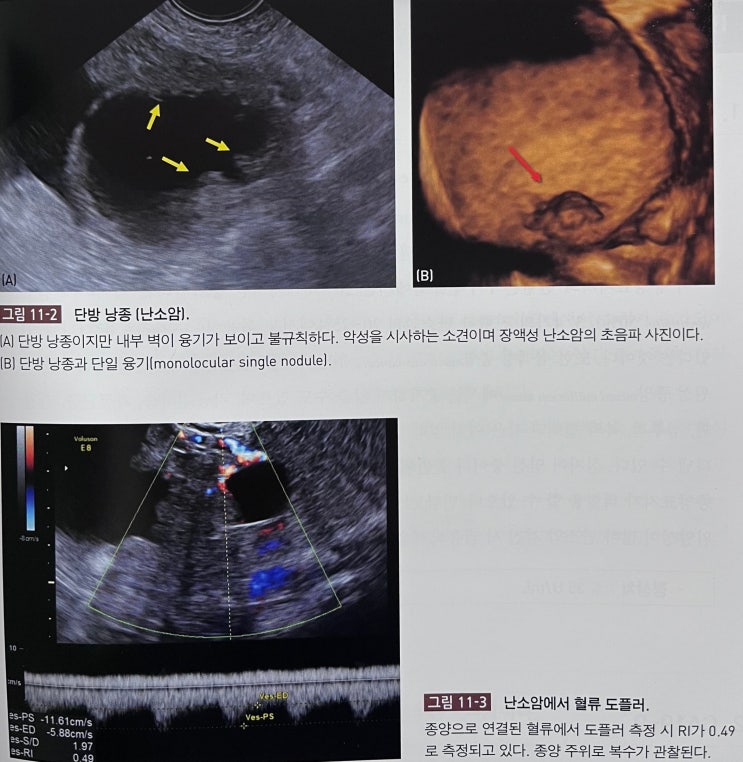  난소암 검사방법이 있다? _ 부인과 검진 1편