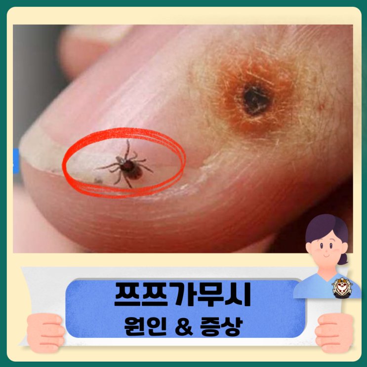  쯔쯔가무시 증상 진드기 원인
