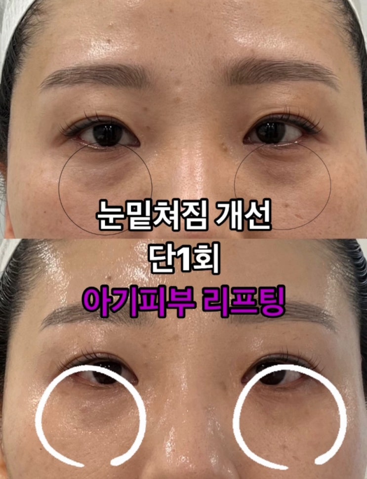  대구피부관리 물광촉촉 수분폭탄 !스킨케어 리프팅 플라즈마 전문센터 아미뷰티! !