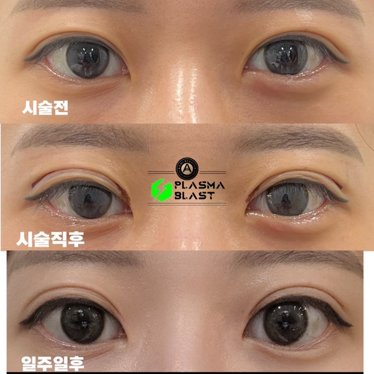  플라즈마쌍꺼풀 부작용 없이 예쁜 눈매라인 완성!모든고민을 대구 아미뷰티에서 해결!