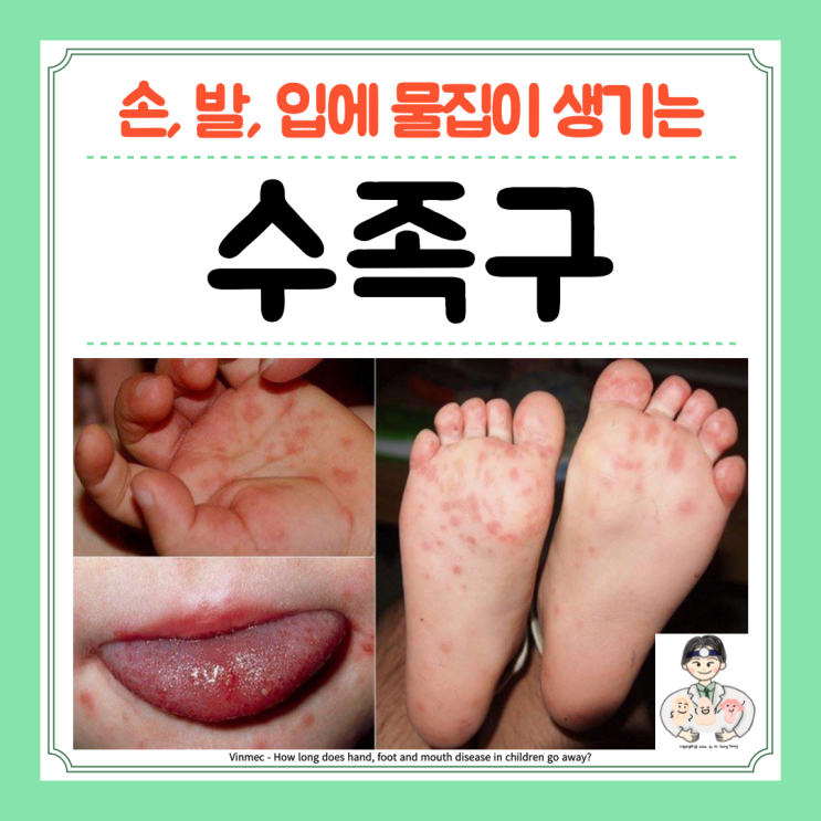  아기 수족구, 성인 수족구병, 잠복기 증상 전염 약 격리 기간