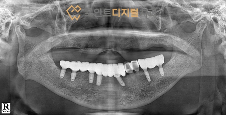  [탕정치과] 디지털 가이드(서지컬 가이드, 네비게이션)를 이용한 전악 임플란트 수복(덴티움) / 천안 아산