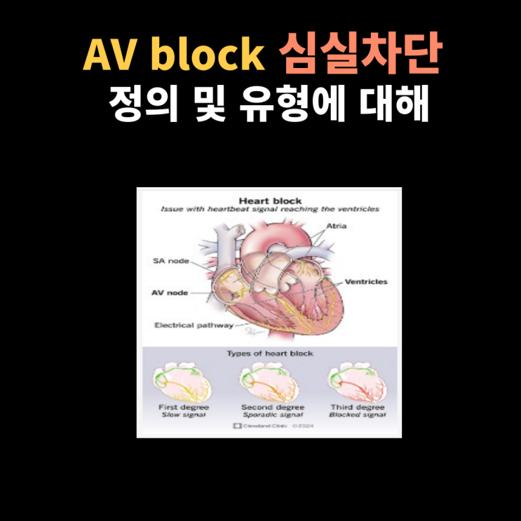  AV block 정의 및 유형에 대해서 간호사 관점에서 알아보아요~