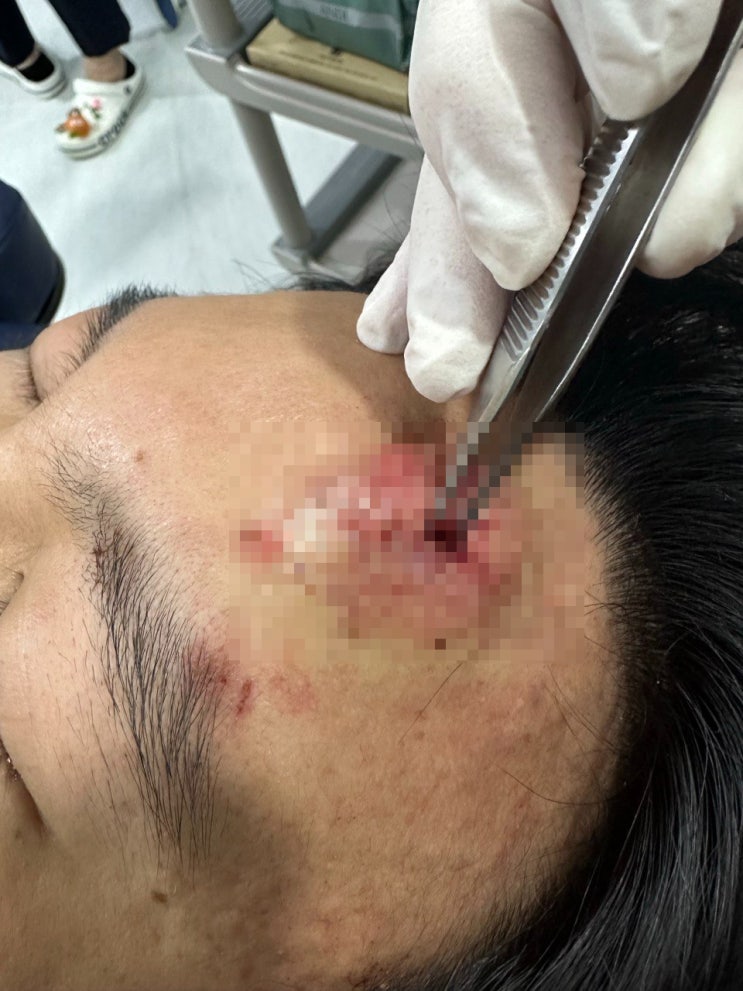  패이고 찢어진 이마, 급하게 봉합수술이 필요할때