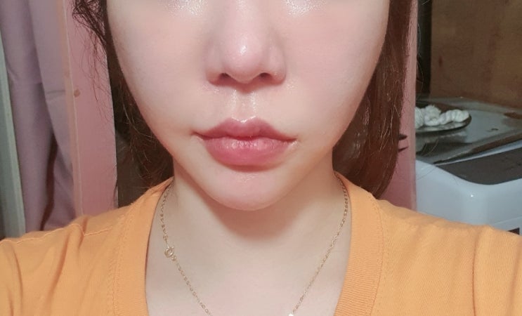  압구정로데오피부과 얼굴지방분해주사 순삭주사 당일붓기와 일주일후기