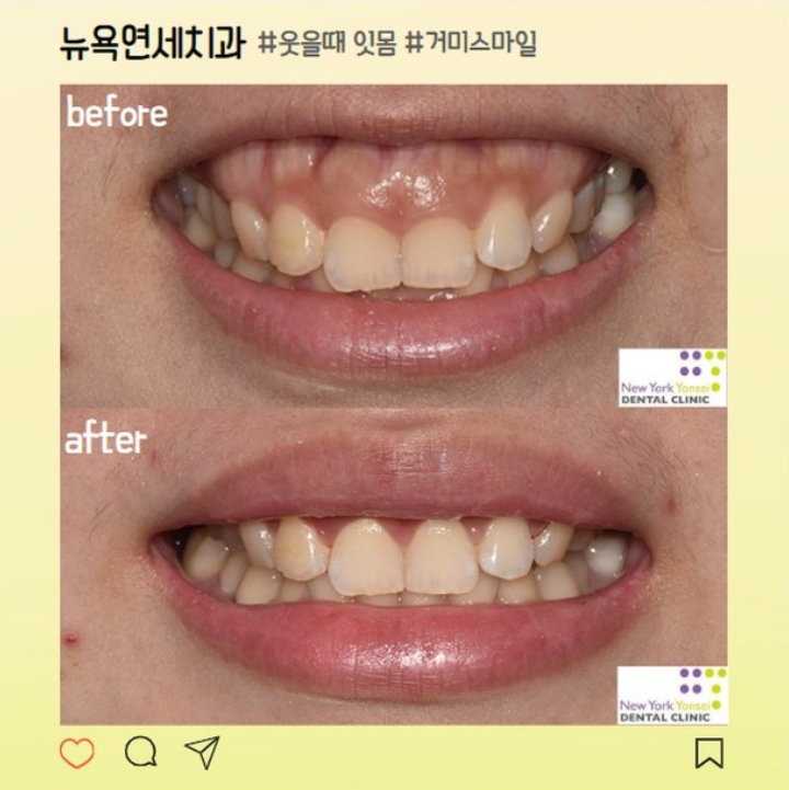  강남역치과추천 잇몸웃음 거미스마일 수술 후기 (구강전정술, 입술재배치술)
