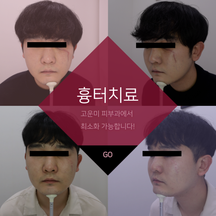  대구반월당흉터치료 오래된 상처, 수술, 흉터를 최소화하는 고운미 피부과의 치료 프로그램