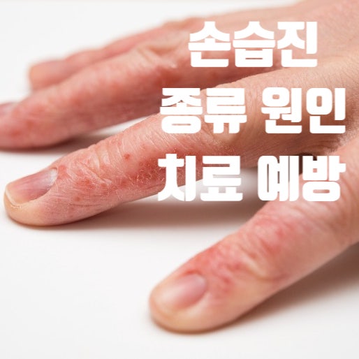 손습진(Hand eczema)의 종류, 원인, 치료와 예방
