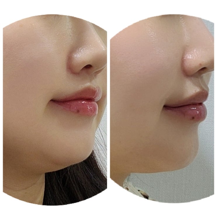  부산피부과 프라임레이즈 리프팅 이중턱관리 후기