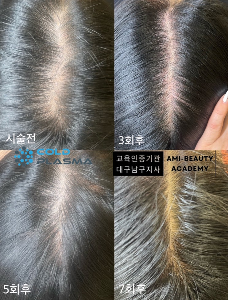  콜드플라즈마 지루성두피 두피건선 탈모 대구 아미뷰티에서 완벽개선 !