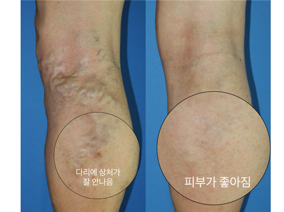  하지정맥류 가려움 색소침착 피부염 증상