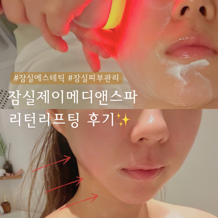  잠실에스테틱 제이메디앤스파 | 리턴리프팅 후기