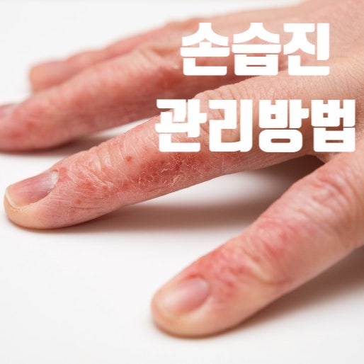  만성 손습진 환자의 관리방법, 홈케어