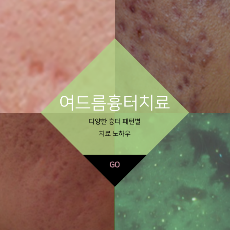  대구반월당피부과 여드름흉터 패턴별 치료 고운미피부과에서 제안합니다