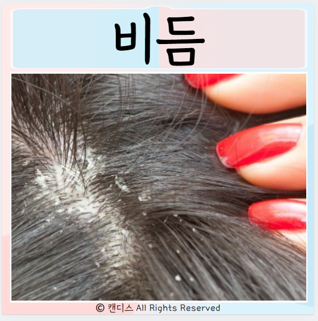  비듬 원인 머리에 하얀 가루 관리하기