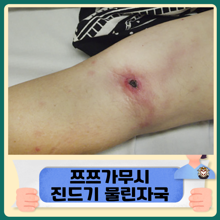  쯔쯔가무시 진드기 물린자국 확인 치료 및 예방하기