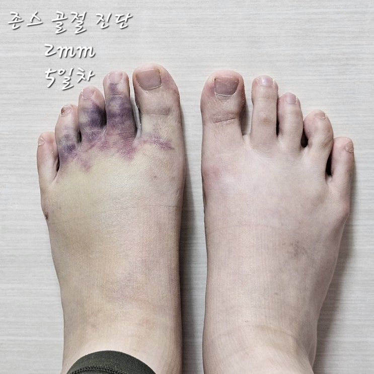  존스 골절. 8일차