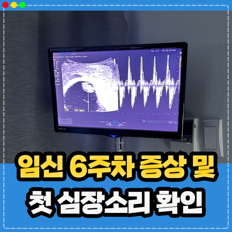  임신 6주 심장소리 확인, 임신 6주차 증상 입덧에 관하여