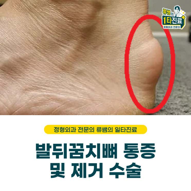  발뒤꿈치뼈 통증/ 뼈제거 수술 (의사작성)