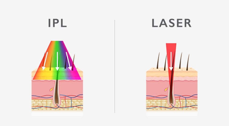  ipl 레이저, 기미 치료 효과와 부작용은?