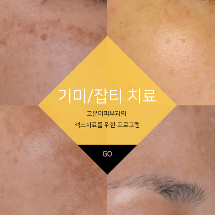  대구반월당색소치료 기미, 잡티 치료로 밝고 깨끗한 피부 만들기