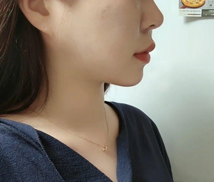  강남튠페이스 턱라인 변화 시술시간 및 2주후기