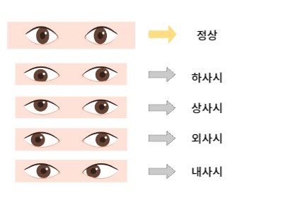  간헐적 외사시 수술 아기사시 유아사시 눈사시 사시치료