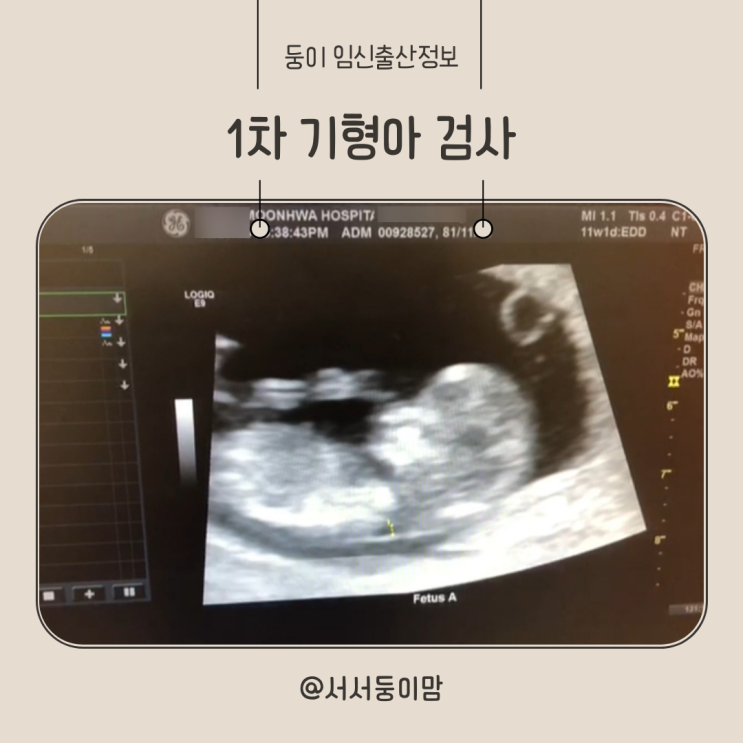  1차 기형아 검사 시기 비용 성별 목투명대 결과