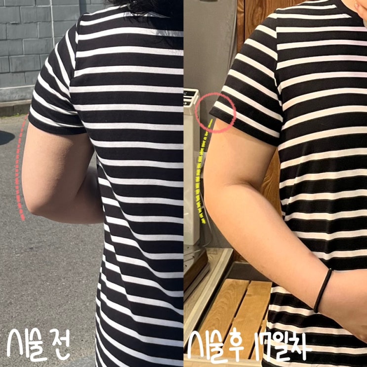  상체 다이어트 노원 팔뚝지방추출주사 4주 차 체중, 사이즈, 멍, 통증 후기(-4cm 경과 추가)