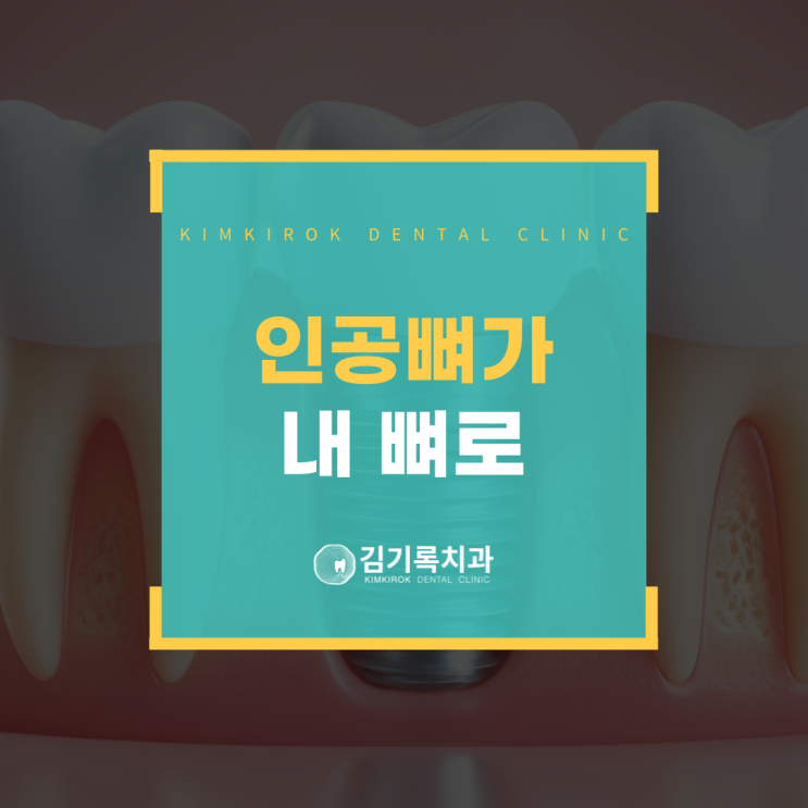 영통임플란트뼈이식 인공뼈도 이식하면 내 뼈로 진짜 바뀌나요?