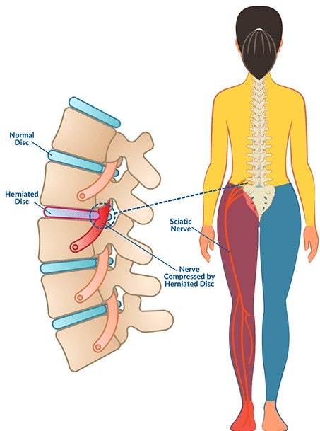  수영구 정형) 허리디스크엔 수술보다 먼저 신경차단술, 광안리재활