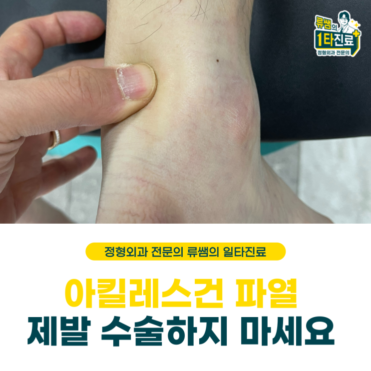  아킬레스건 파열 수술 안 해도 됩니다.  (의사작성)