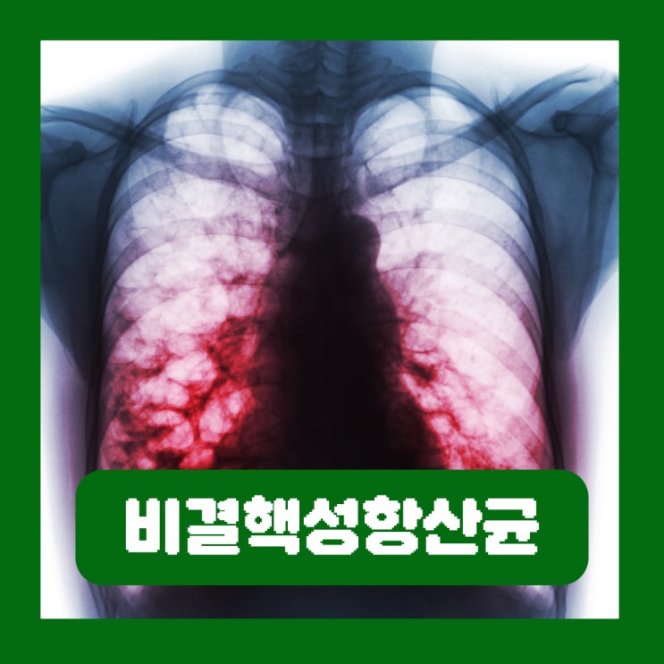  건강검진 비결핵성항산균 폐질환 증상 검사 치료