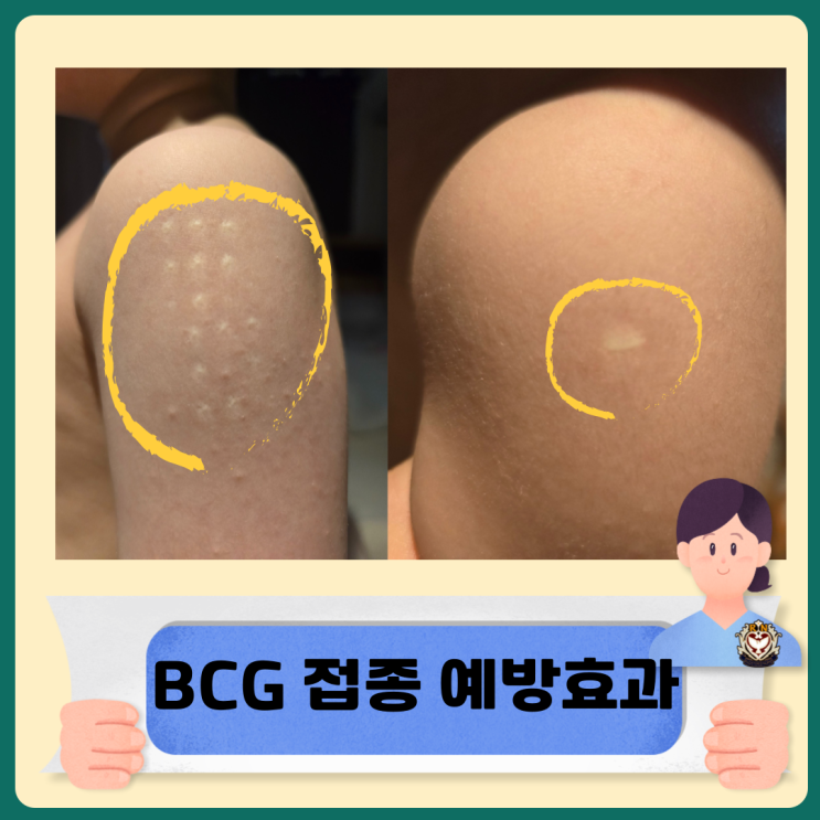  BCG 접종 예방효과와 적응증 및 이상반응