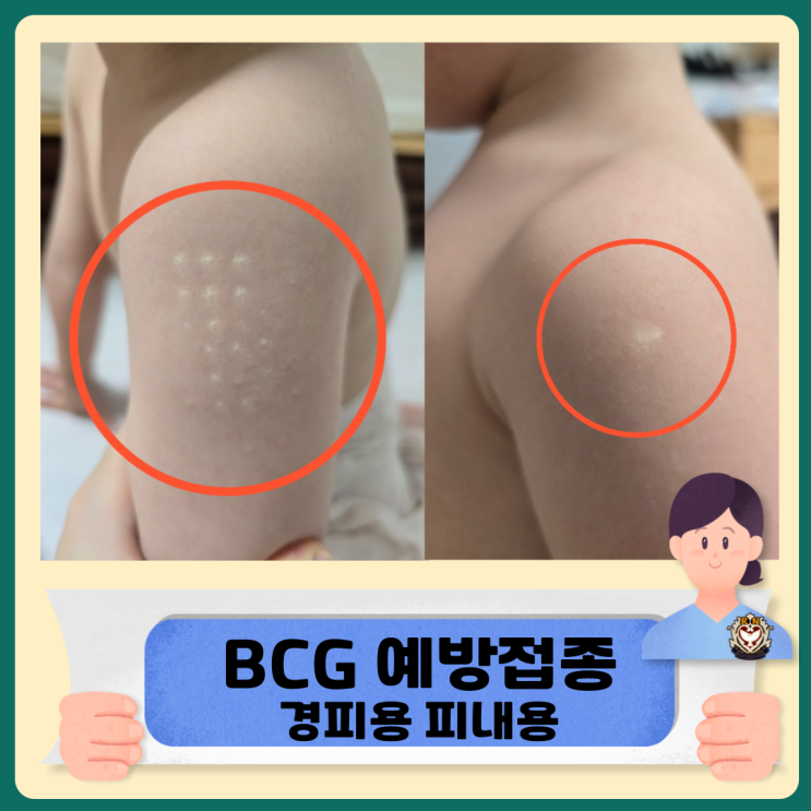  BCG 경피용 피내용 결핵 예방접종 불주사 맞는 이유 흉터사진