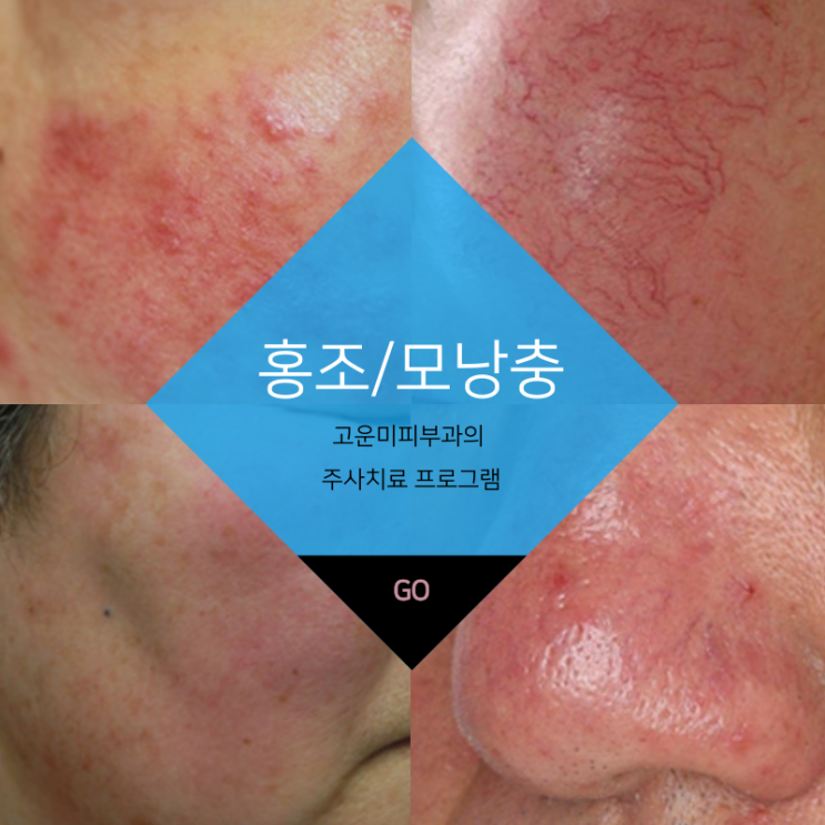  대구반월당홍조치료 빨간 얼굴과 화끈거리는 홍조와 모낭염의 치료