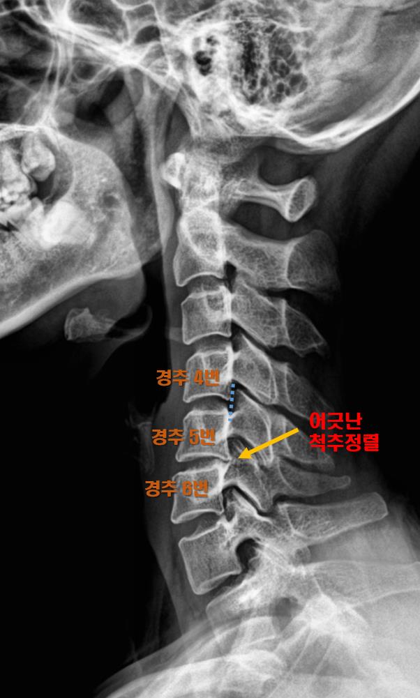  광주 남구 정형외과, 경추후관절증후군? 목디스크?