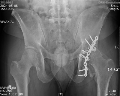 PELVIS AP, OBL,INLET,OUTLET,HIP JOINT 골반일반 촬영법 소개 : 네이버 블로그