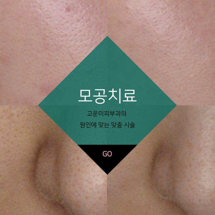  대구반월당모공치료 모공이 넓어진 원인에 찾아 맞춤 시술합니다