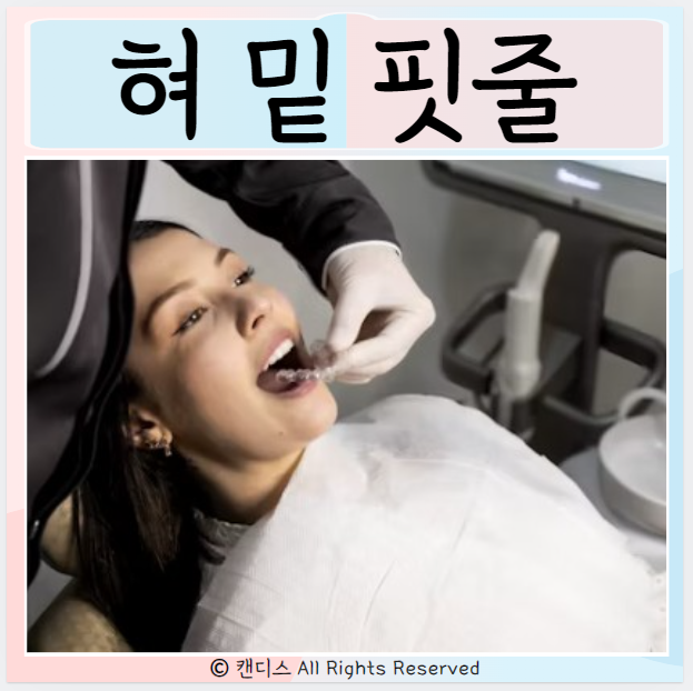  혀 밑 핏줄 증상 설하정맥 설소대 알아보기