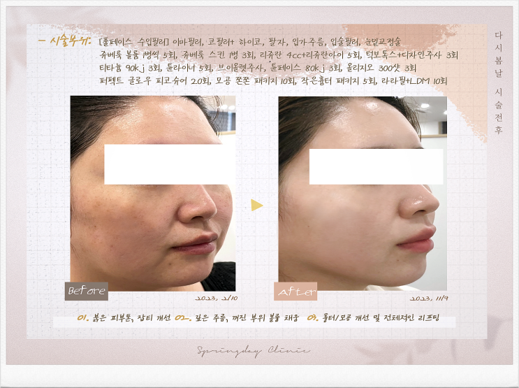  마곡역피부과 리프팅 병행해 시너지 효과