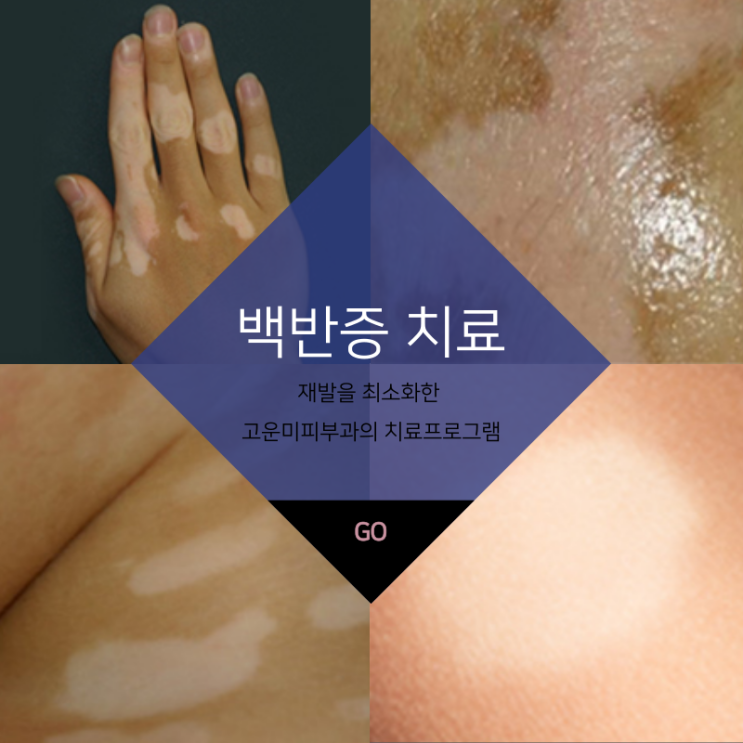  대구반월당백반증치료 재발을 최소화하고 부작용 걱정 없는 엑시머레이저 치료