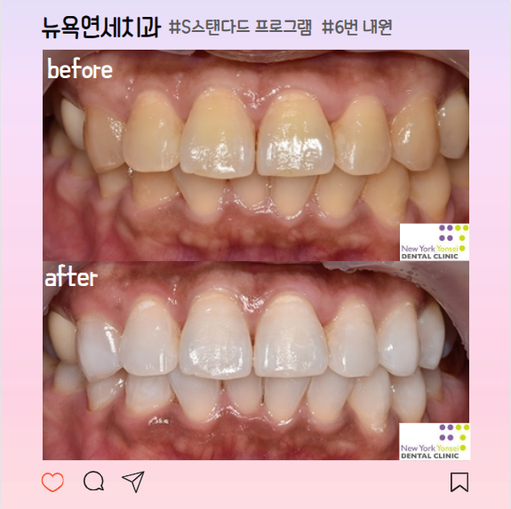 강남역치아미백 원인과 맞춤형 진단을 통해