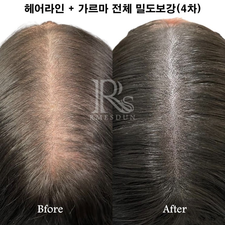  깔끔한 이미지를 원한다면 부산가르마문신이 답이다!
