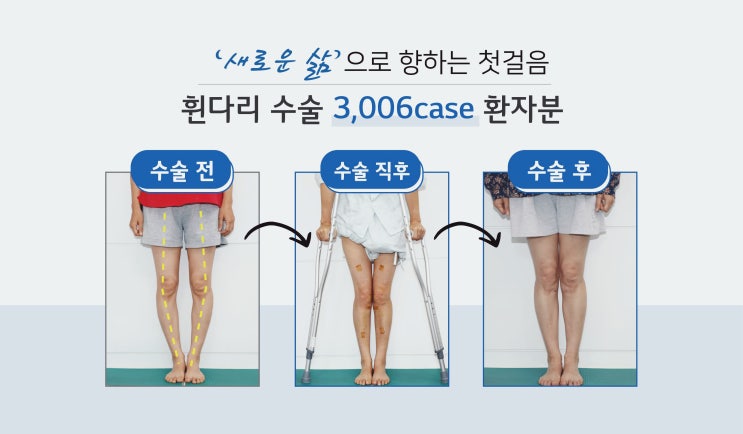 휜다리가 고민이라면? [뉴본정형외과/휜다리수술]