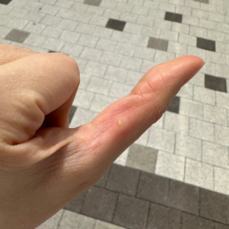 세종피부과 손사마귀 냉동치료, 얼굴사마귀 레이저치료 후기(통증, 흉터, 비용, 실비 등)