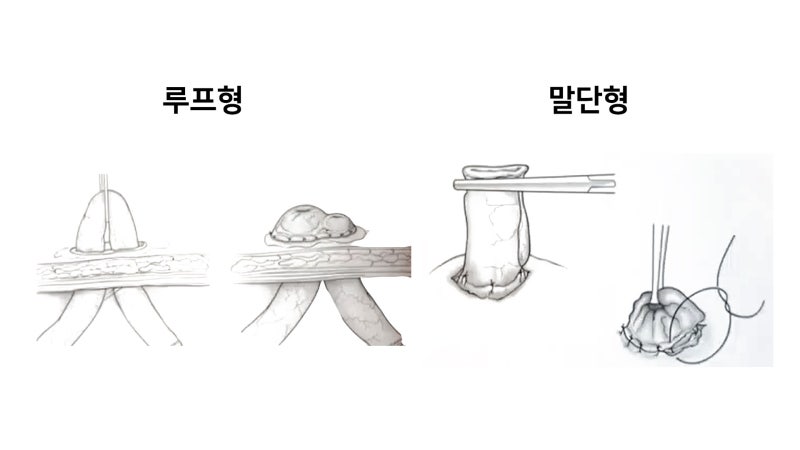인공 장루 수술과 복원수술 및 부작용 : 네이버 블로그